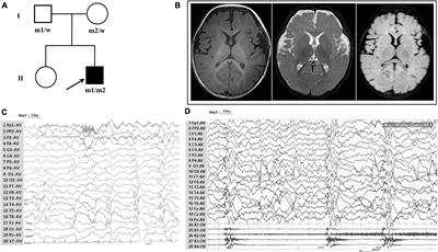 Role of TRAK1 variants in epilepsy: genotype–phenotype analysis in a pediatric case of epilepsy with developmental disorder